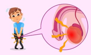 Male Infertility Symptom