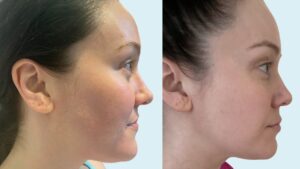 Success Rate Of HIFU Treatment